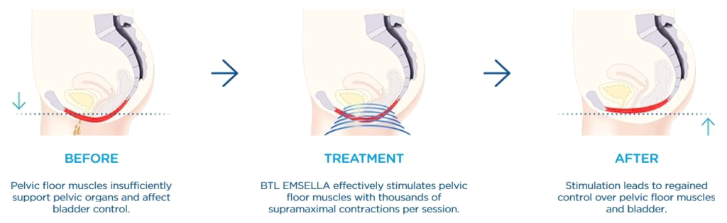 emsella incontinence treatment east lansing