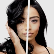 m acne scar reduction