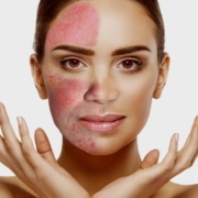 rosacea treatment