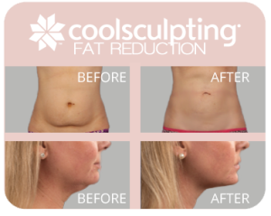 p coolsculpting lansing p coolsculpting lansing