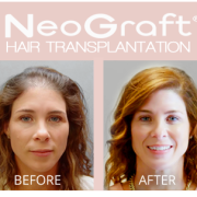 p hair transplant lansing