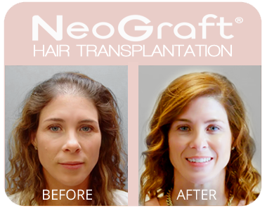 p hair transplant lansing