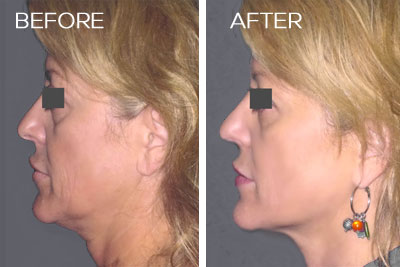 Precision TX Nonsurgical Neck Lift