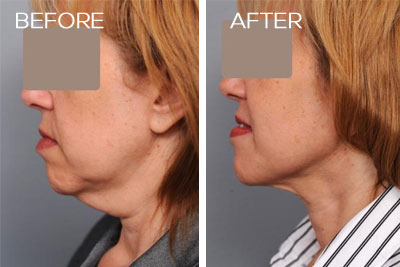 Precision TX Nonsurgical Neck Lift