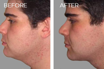 Precision TX Nonsurgical Neck Lift
