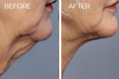 Precision TX Nonsurgical Neck Lift