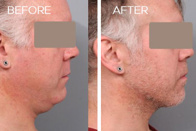 Precision TX Nonsurgical Neck Lift