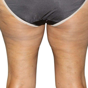 cellulite 2 after