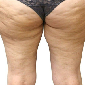 cellulite 2 before