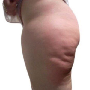 cellulite 3 before