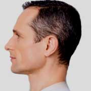 skin tightening