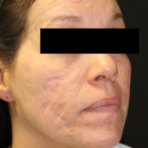 venus viva acne before3
