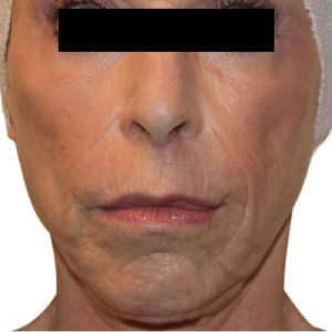 venus versa wrinkle after venus versa wrinkle after