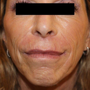 venus versa wrinkle before venus versa wrinkle before