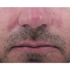 venus viva redness after venus viva redness after