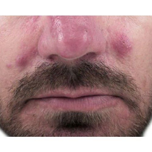 venus viva redness before venus viva redness before