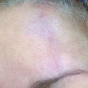 venus viva scar after