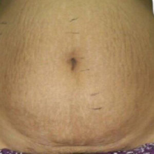venus viva stretchmrk after
