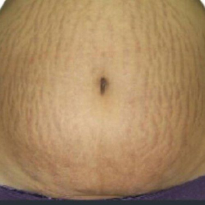 venus viva stretchmrk before