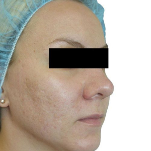 viva acne after1